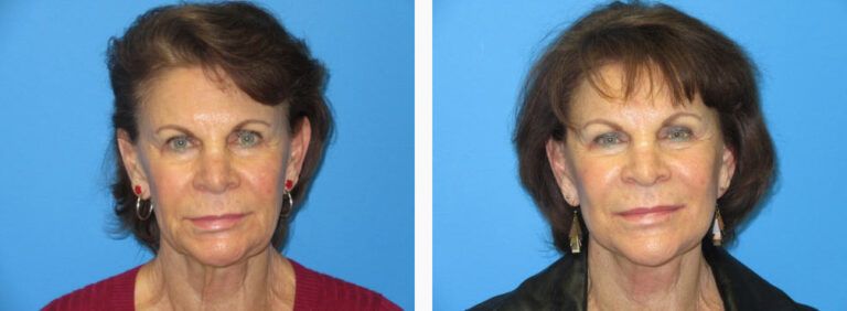 Facelift Platysmaplasty before and after treatment