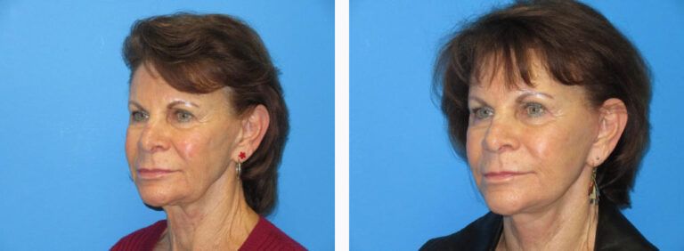 Facelift Platysmaplasty before and after treatment