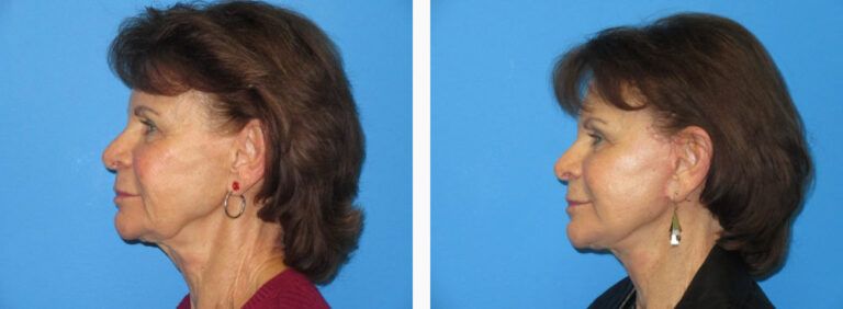 Facelift Platysmaplasty before and after treatment
