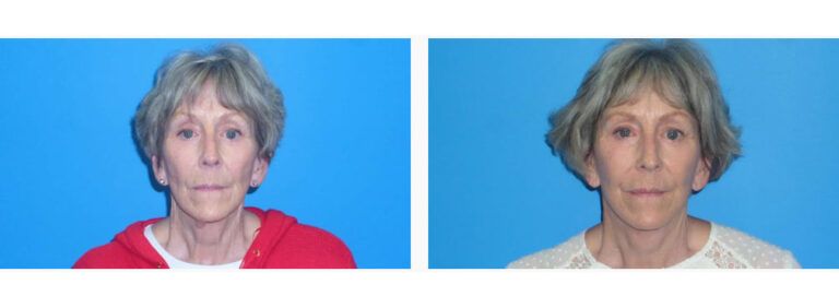 Facelift Platysmaplasty before and after treatment