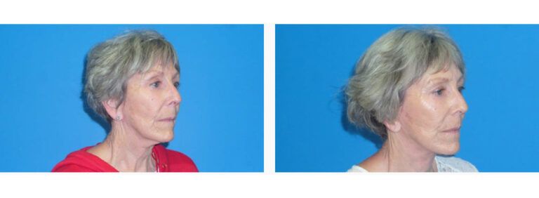 Facelift Platysmaplasty before and after treatment