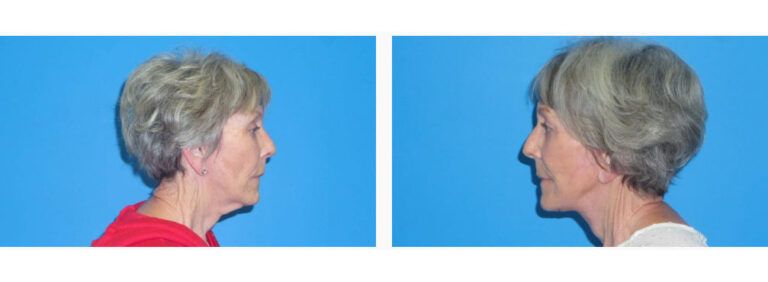 Facelift Platysmaplasty before and after treatment