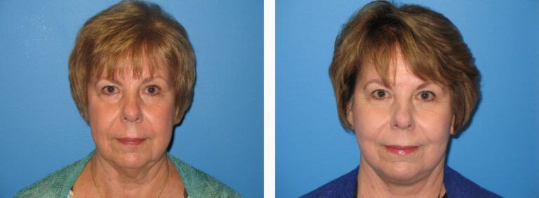 Facelift with Platysmaplasty before and after treatment