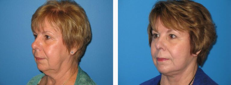 Facelift with Platysmaplasty before and after treatment