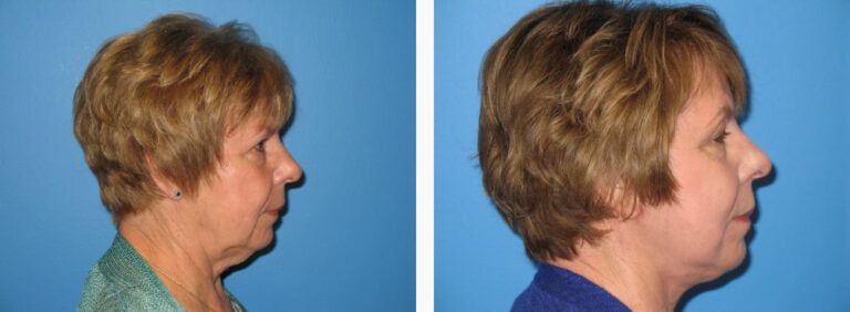 Facelift with Platysmaplasty before and after treatment