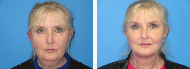Facelift with Platysmaplasty before and after treatment