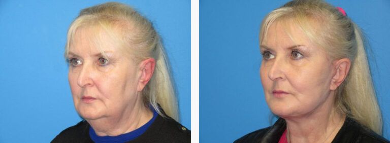 Facelift with Platysmaplasty before and after treatment