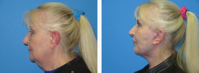 Facelift with Platysmaplasty before and after treatment