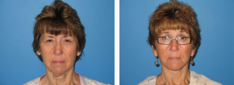 Facelift with Platysmaplasty before and after treatment