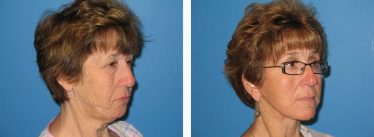 Facelift with Platysmaplasty before and after treatment
