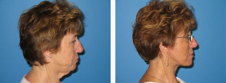 Facelift with Platysmaplasty before and after treatment