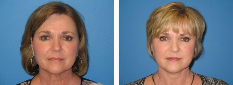 Facelift with Platysmaplasty before and after treatment