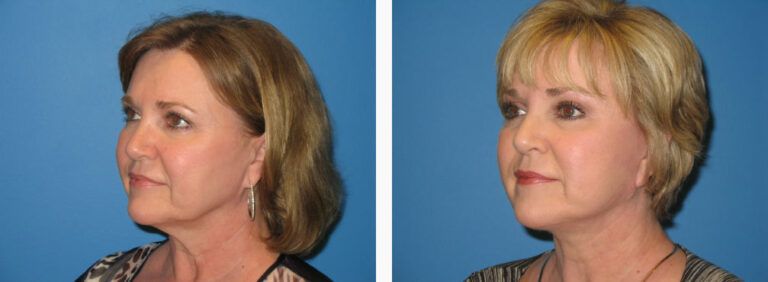 Facelift with Platysmaplasty before and after treatment