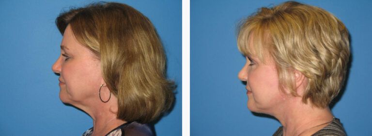 Facelift with Platysmaplasty before and after treatment