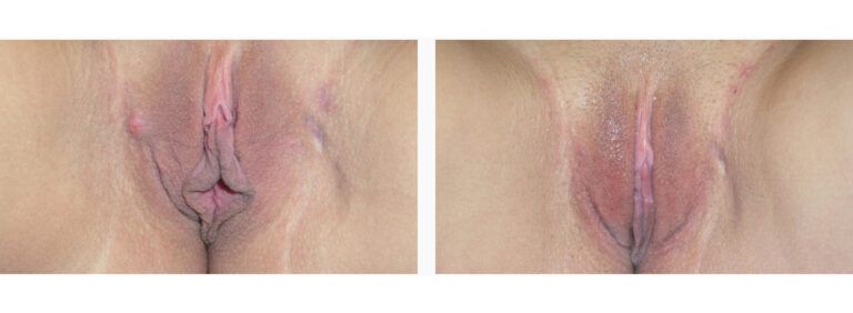 Labiaplasty before and after treatment