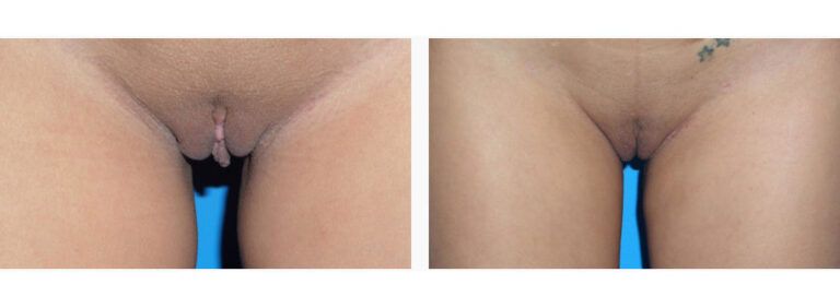 Labiaplasty before and after treatment