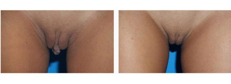 Labiaplasty before and after treatment
