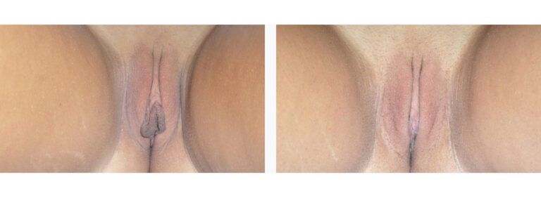 Labiaplasty before and after treatment