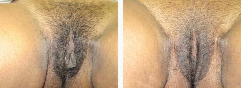 Labiaplasty before and after treatment