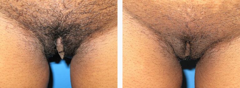 Labiaplasty before and after treatment