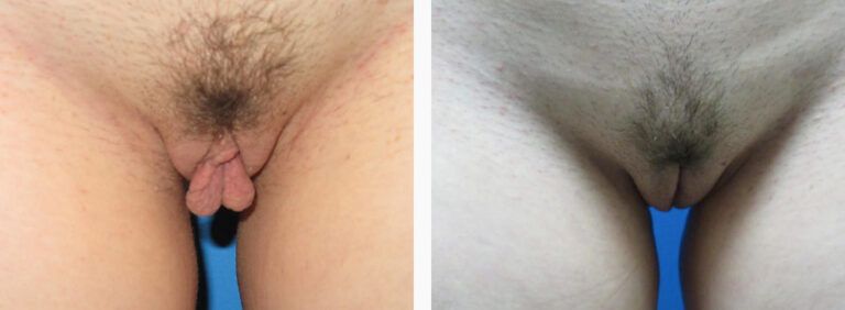 Labiaplasty before and after treatment