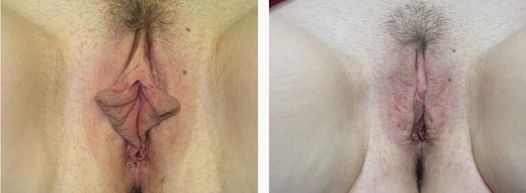 Labiaplasty before and after treatment