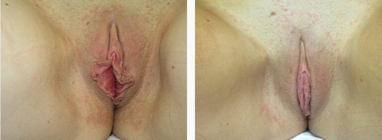 Labiaplasty before and after treatment