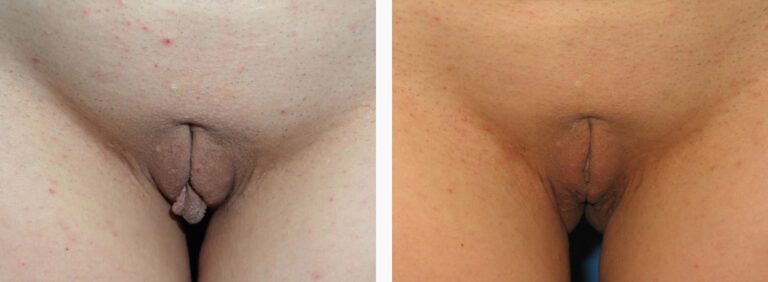 Labiaplasty before and after treatment