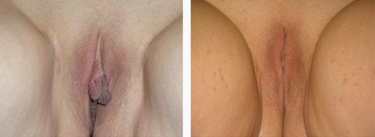 Labiaplasty before and after treatment