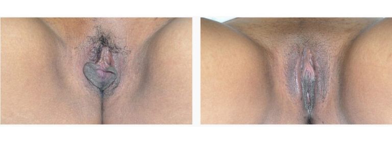 Labiaplasty before and after treatment