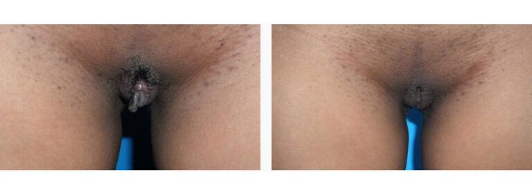 Labiaplasty before and after treatment