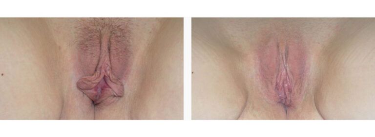Labiaplasty before and after treatment