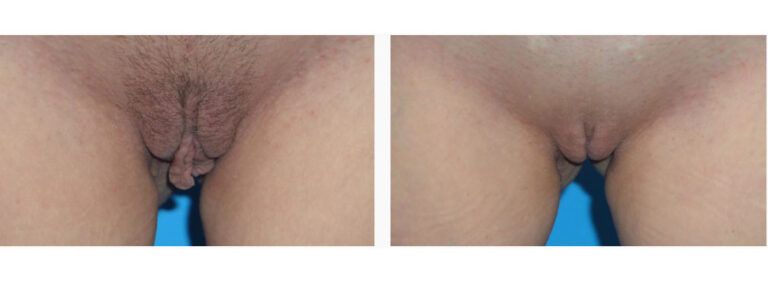 Labiaplasty before and after treatment