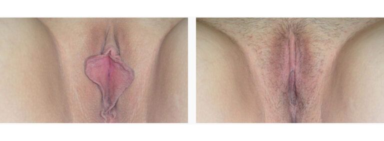 Labiaplasty before and after treatment