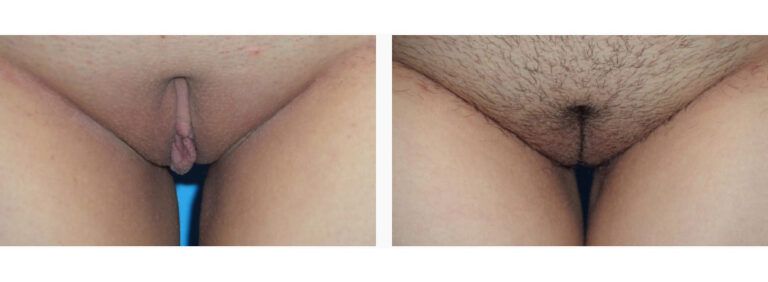 Labiaplasty before and after treatment