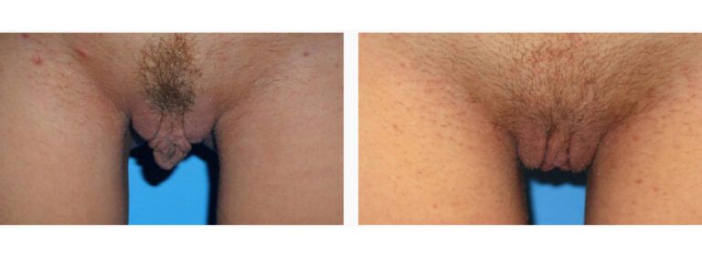 Labiaplasty before and after treatment