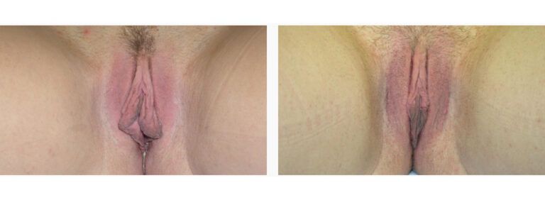 Labiaplasty before and after treatment