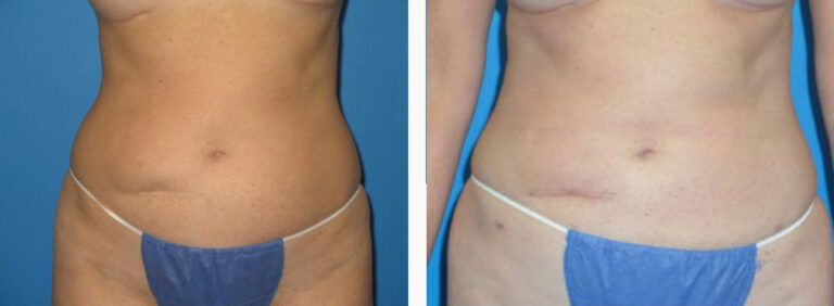 Liposuction before and after treatment