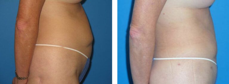 Liposuction before and after treatment