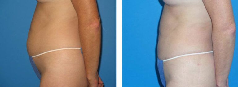 Liposuction before and after treatment