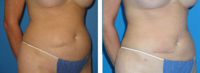 Liposuction before and after treatment