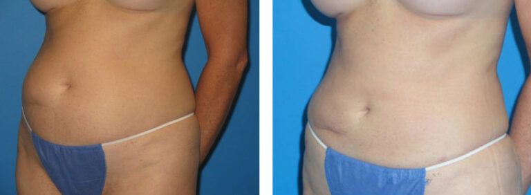 Liposuction before and after treatment