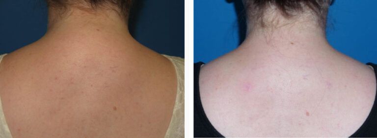 Liposuction before and after treatment