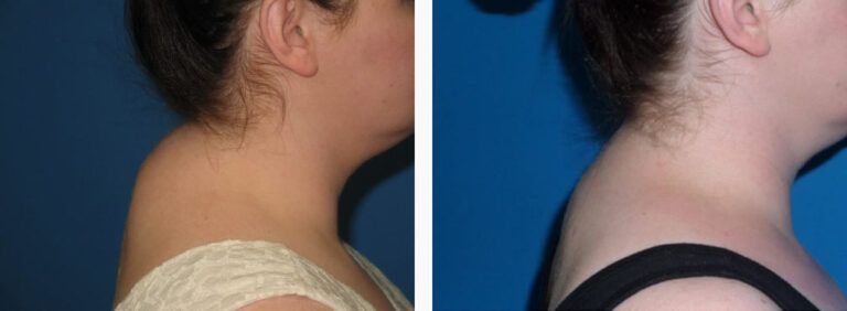 Liposuction before and after treatment