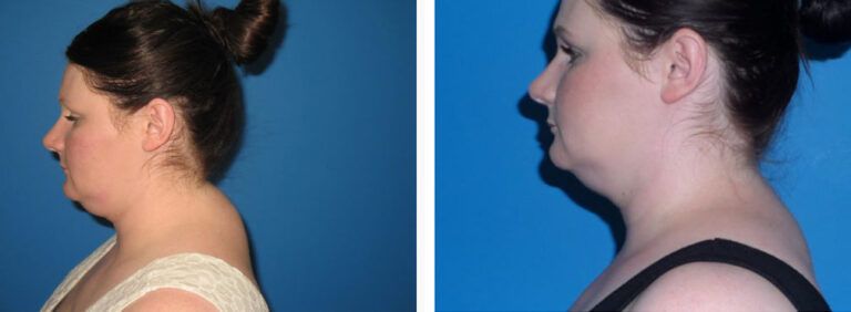 Liposuction before and after treatment