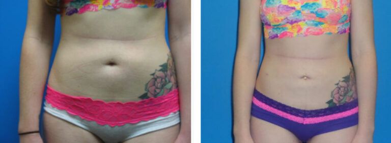Liposuction before and after treatment