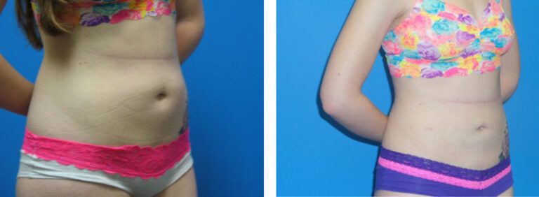 Liposuction before and after treatment