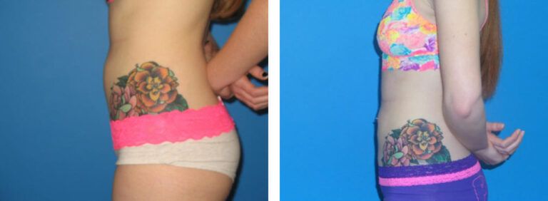 Liposuction before and after treatment