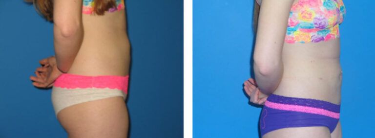 Liposuction before and after treatment