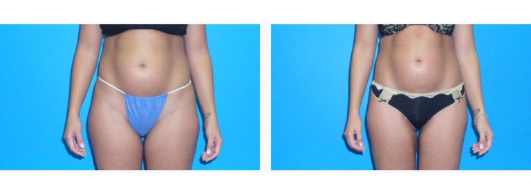Liposuction before and after treatment